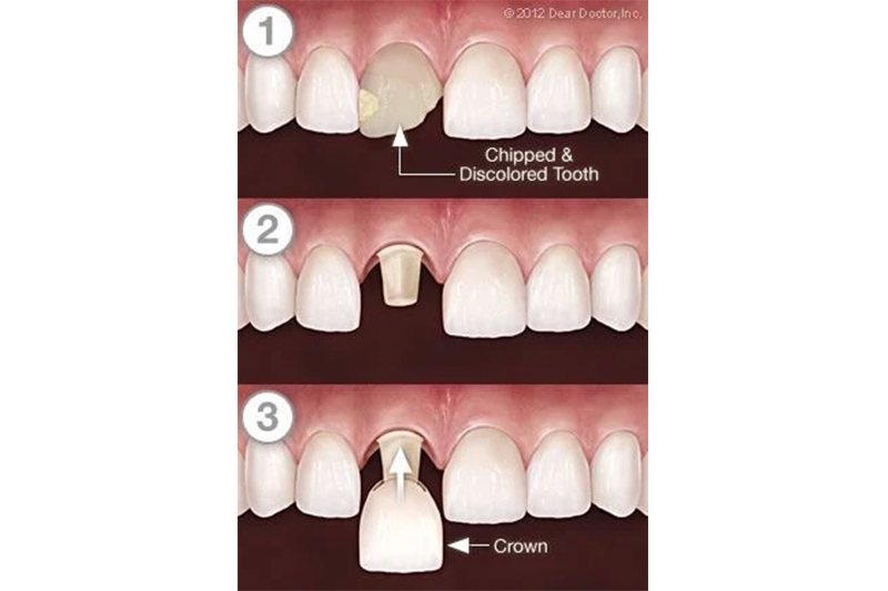 Dental Crowns in Merrimack