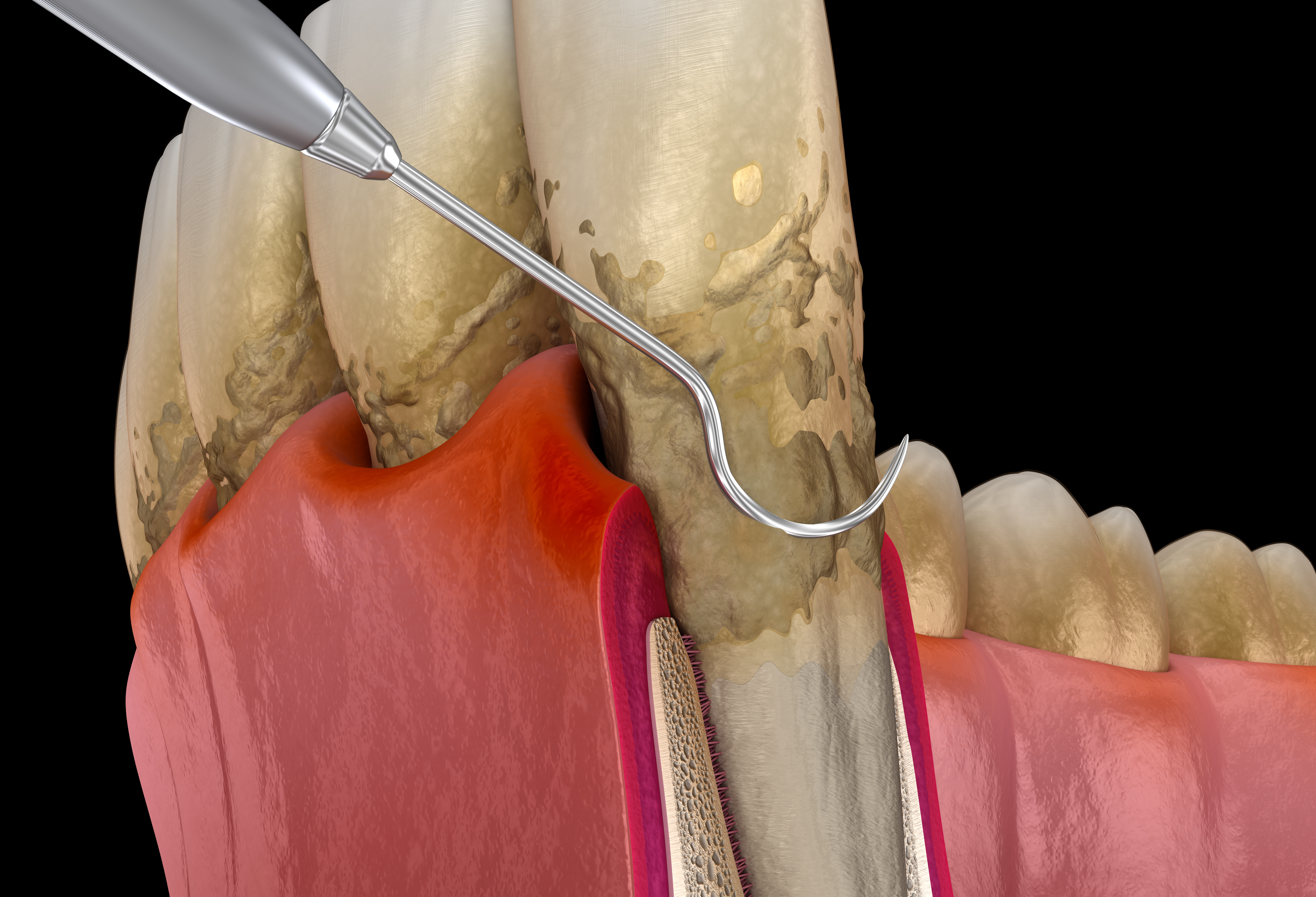 Gum Disease / Periodontal Treatment in Merrimack